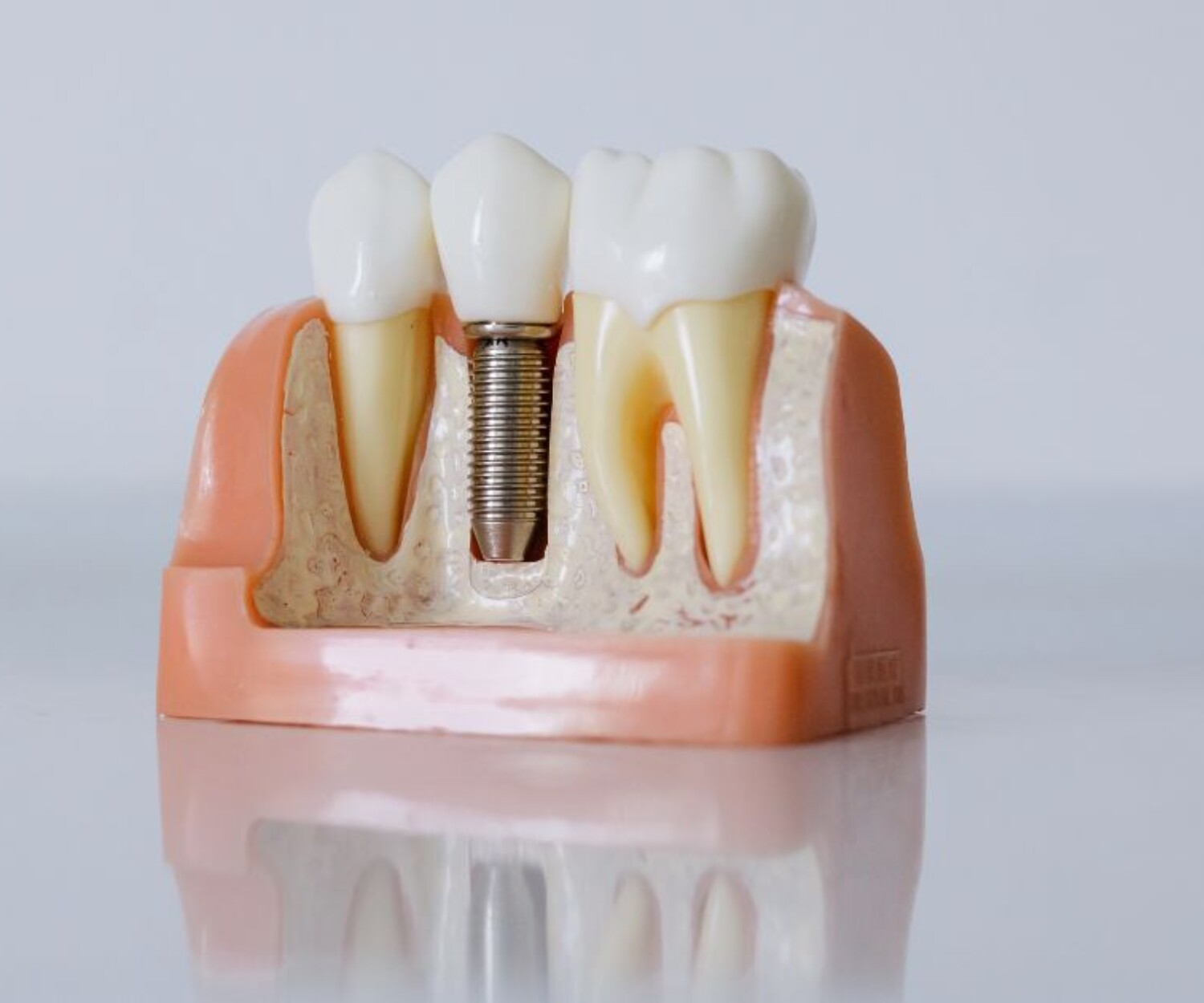 Dental Implant