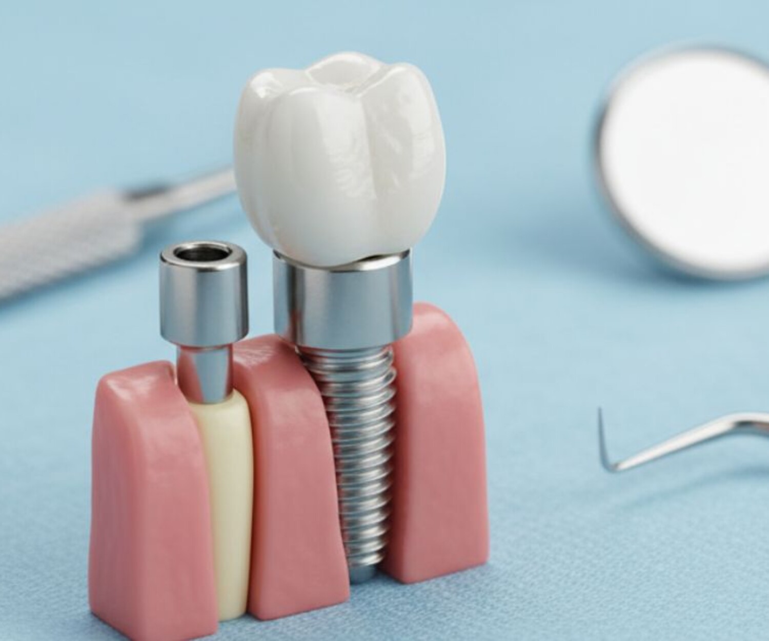 Dental Implant