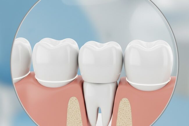 Dental bridge