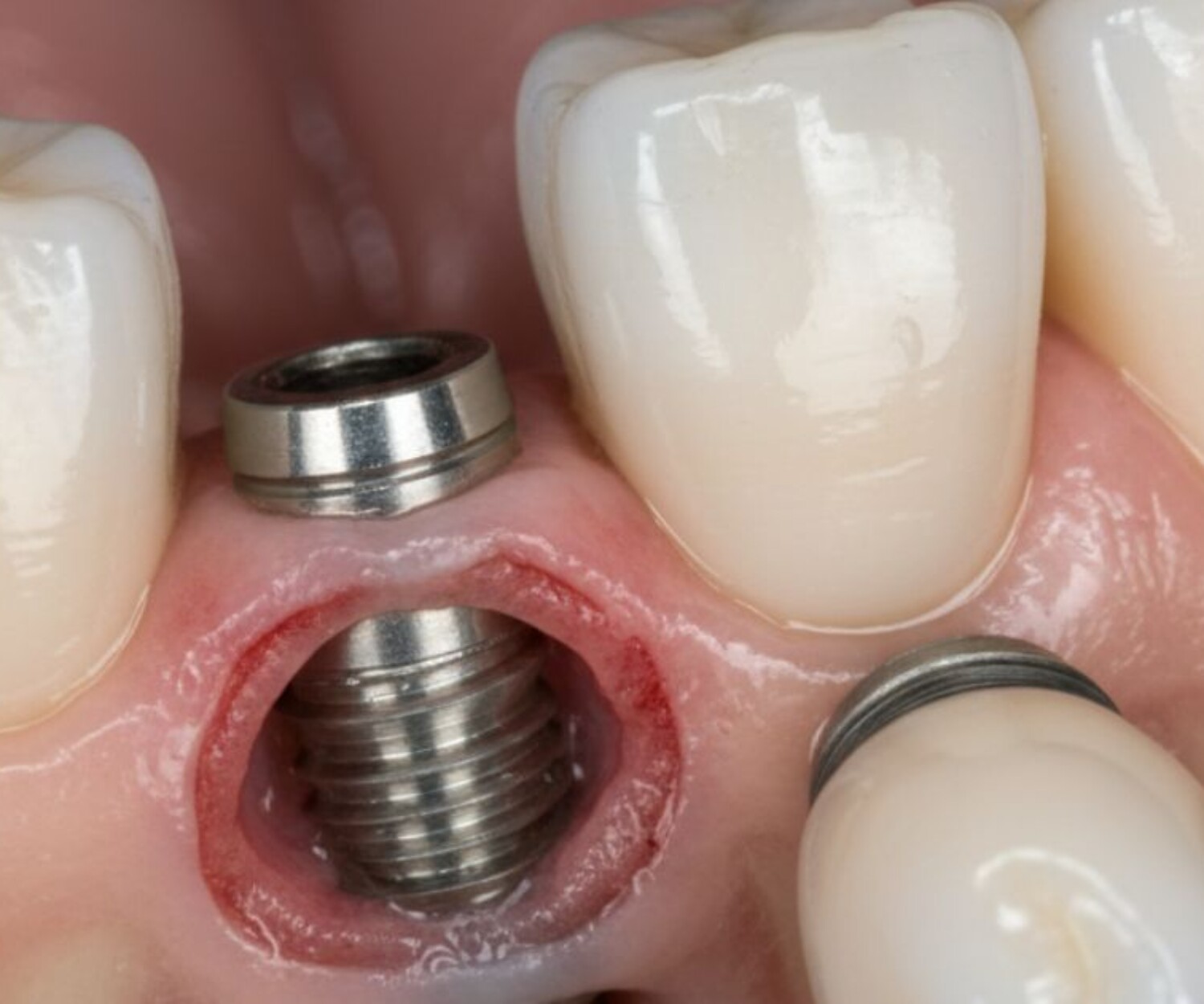Loose dental implant