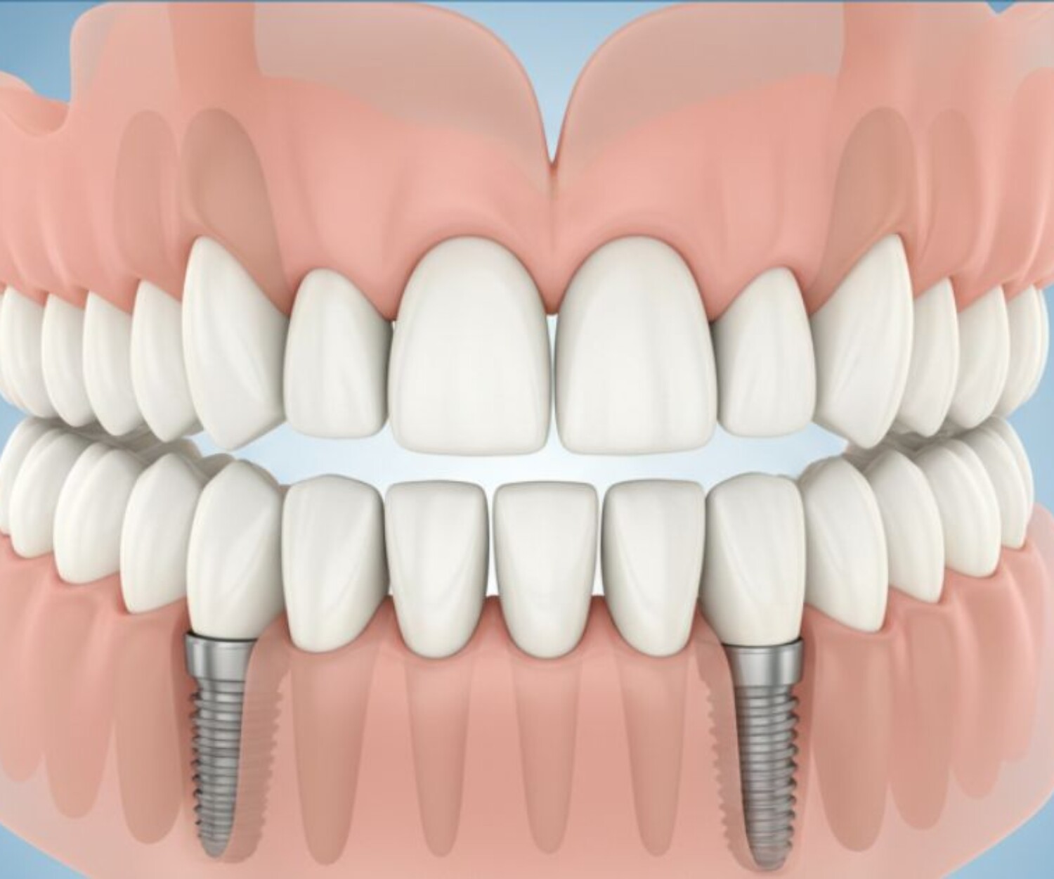 Dental Implants