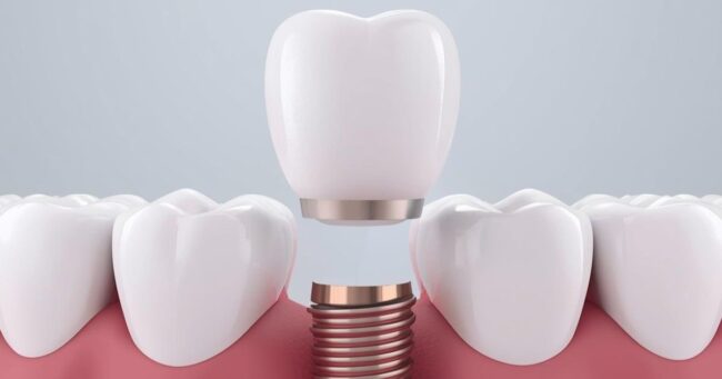 Dental implant placement