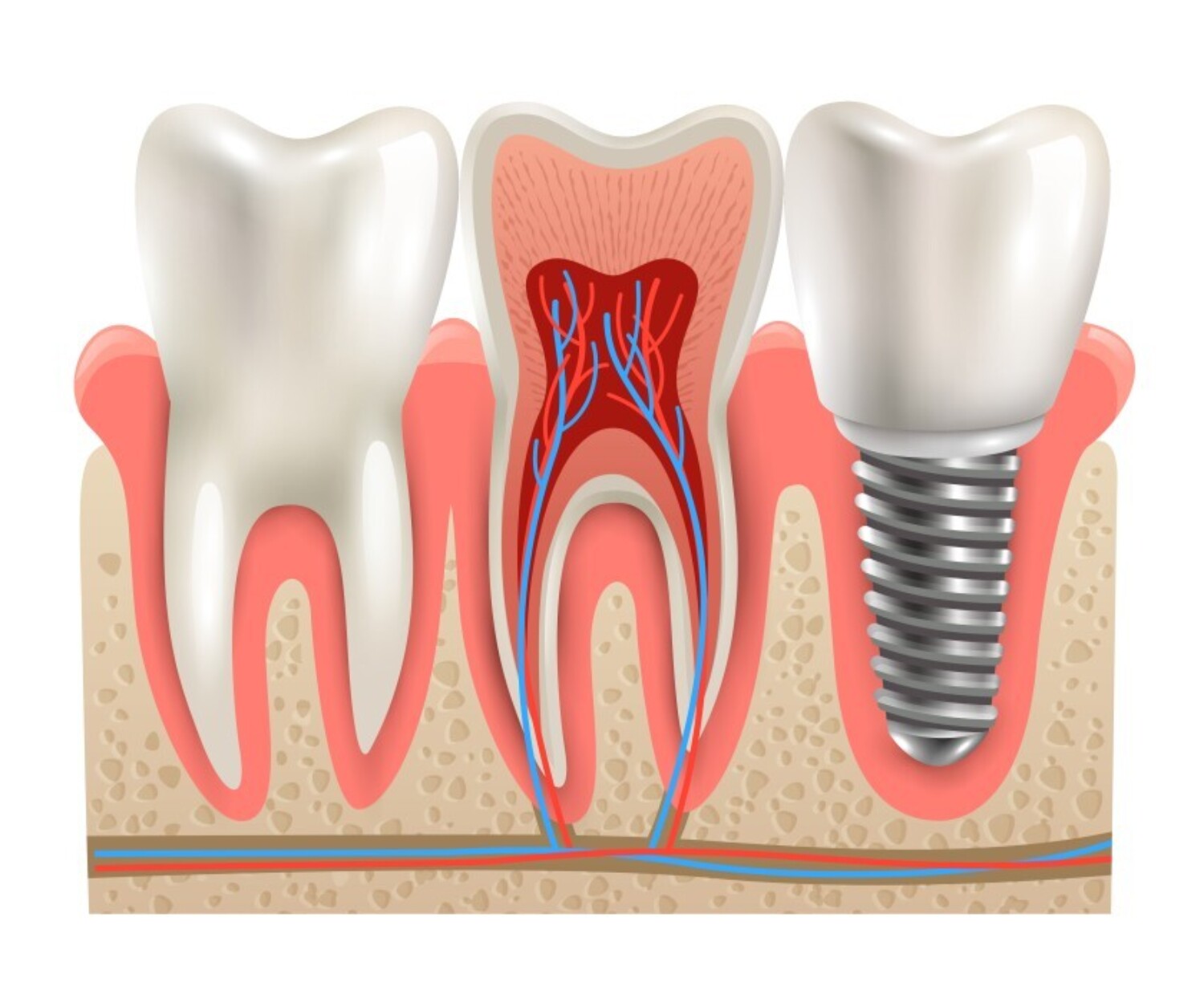 Banner Image for Dental Bone Graft