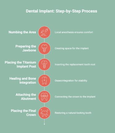 Infographic showcasing the dental implant process