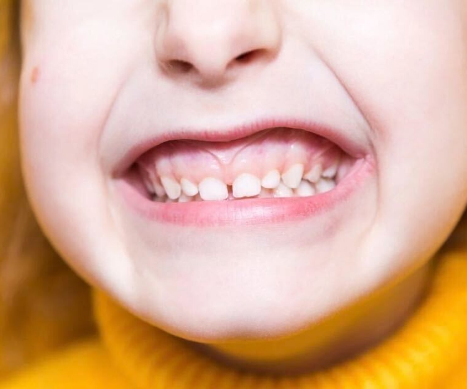 Kid with overbite problem