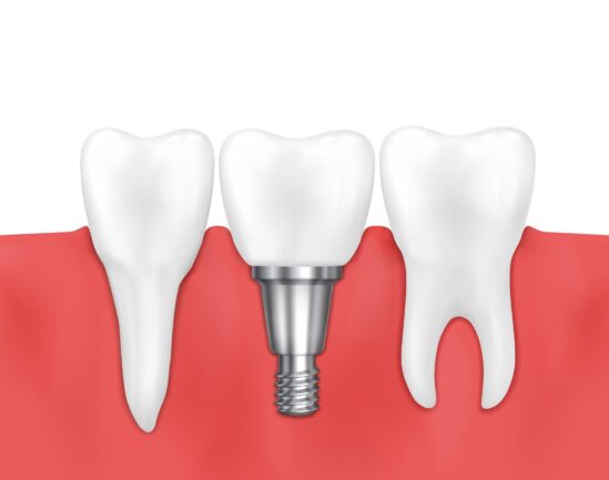 Illustration showing a dental implant placed between two natural teeth, highlighting the implant post and surrounding gum structure.