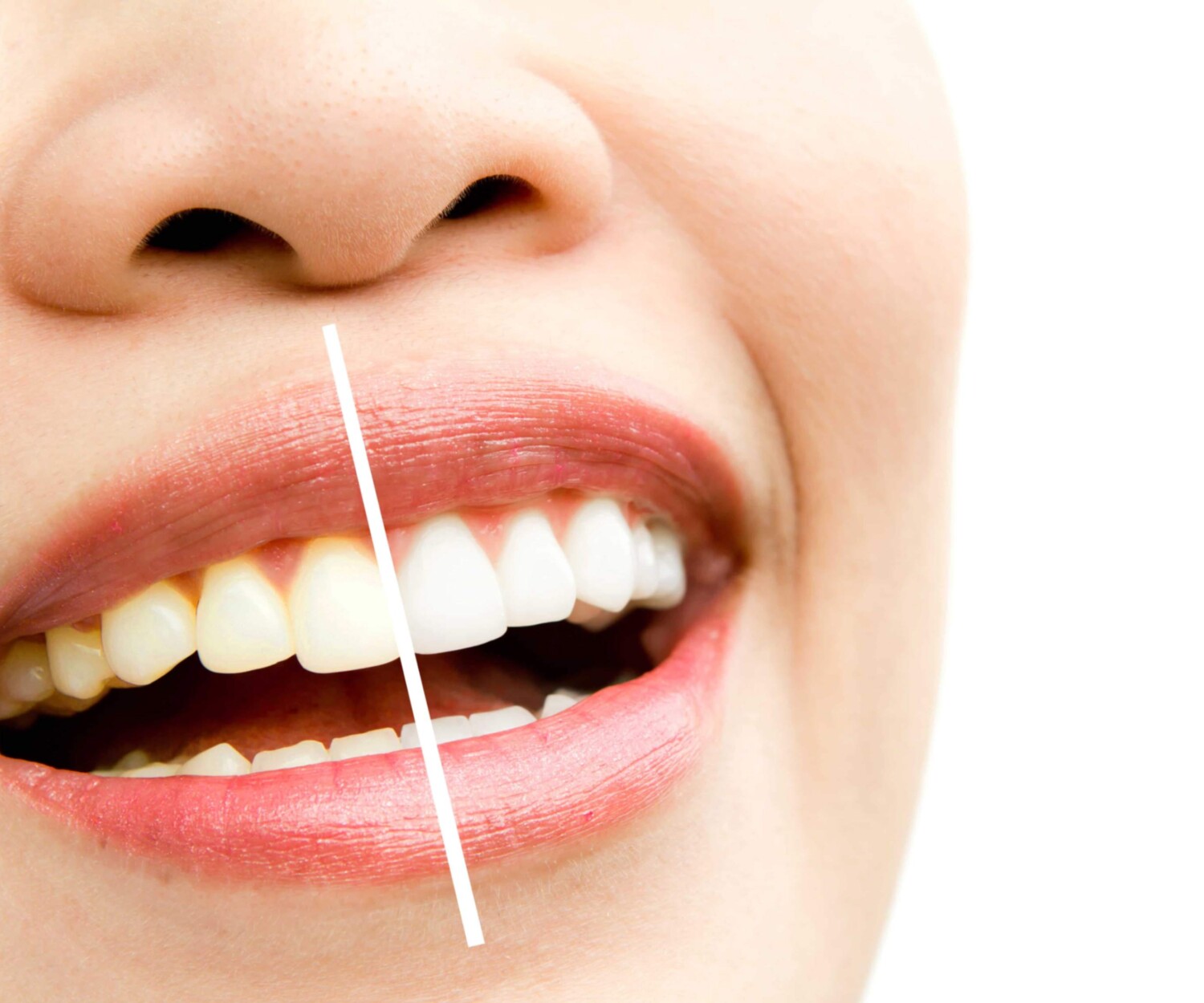 before and after results of teeth whitening
