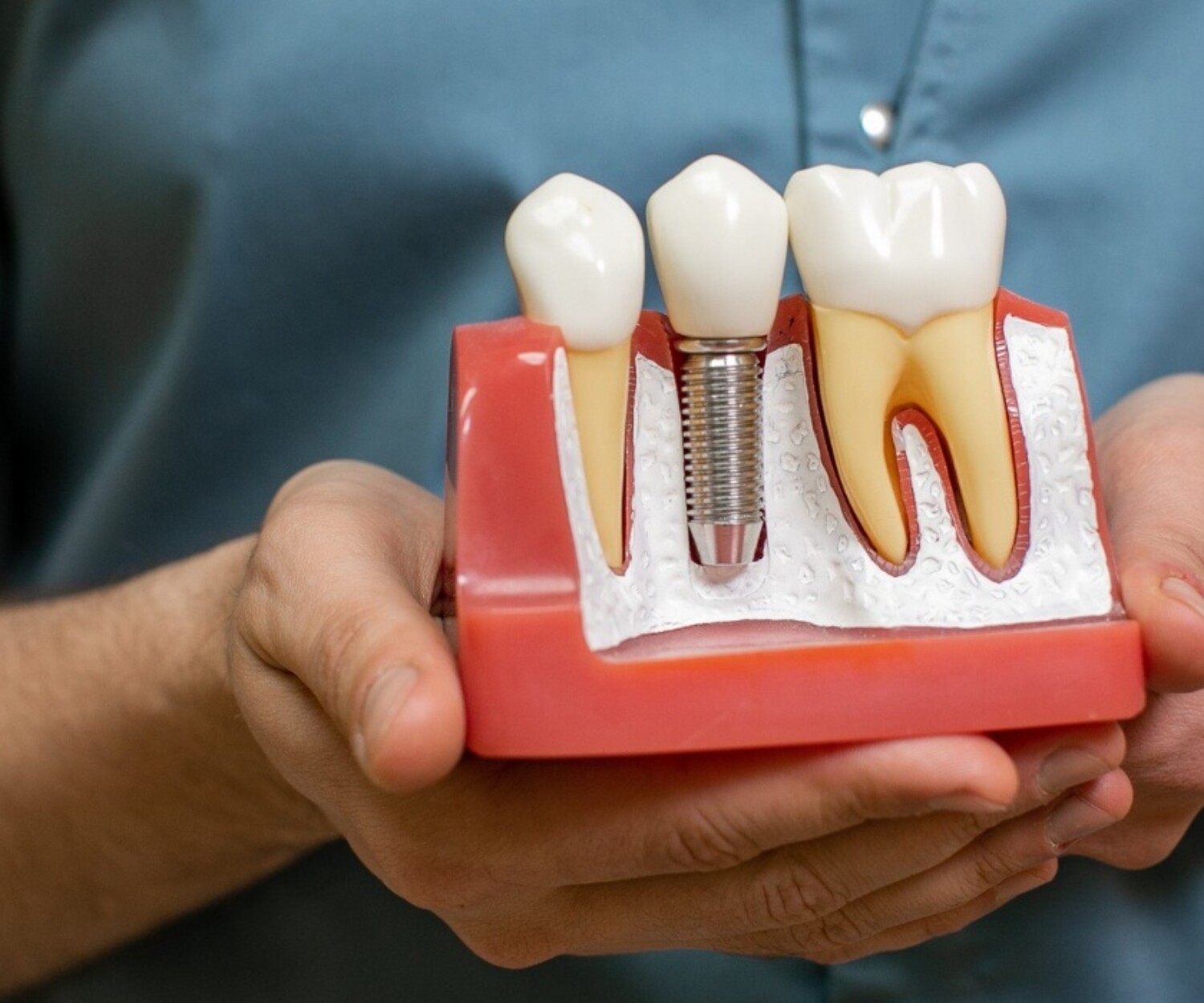 Banner Image of Best Dental Implants