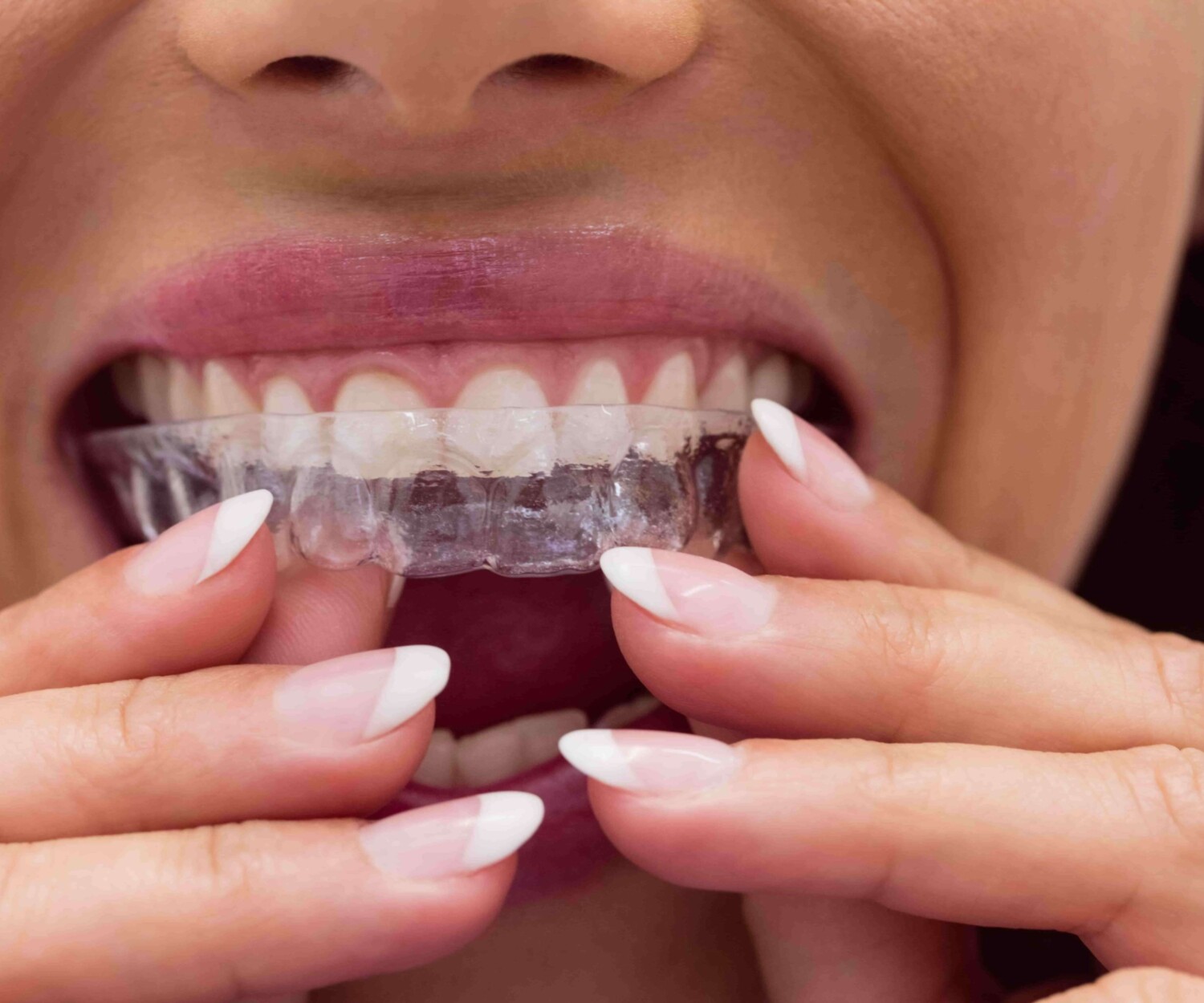Patient putting on invisalign