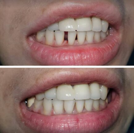 Invisalign before and after images