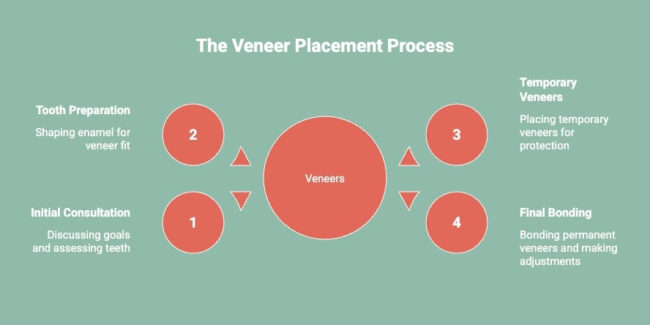 Infographics on the Veneer Placement Process