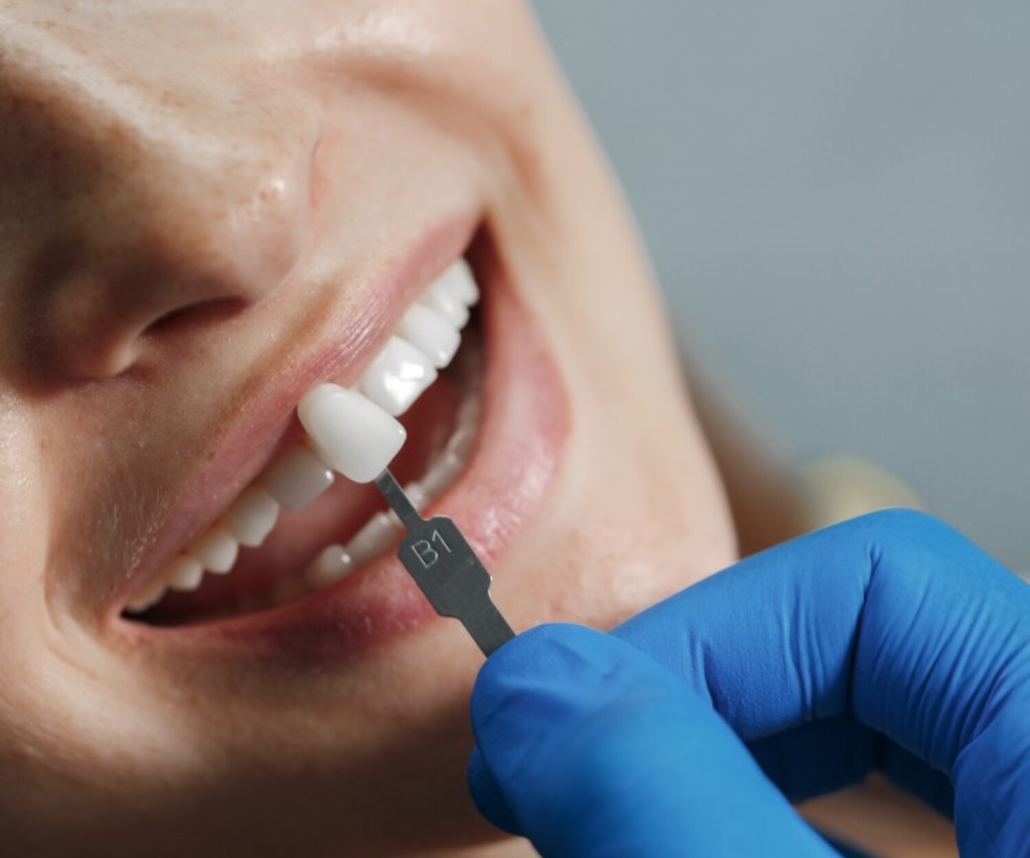 Banner Image of Veneers vs. Crowns