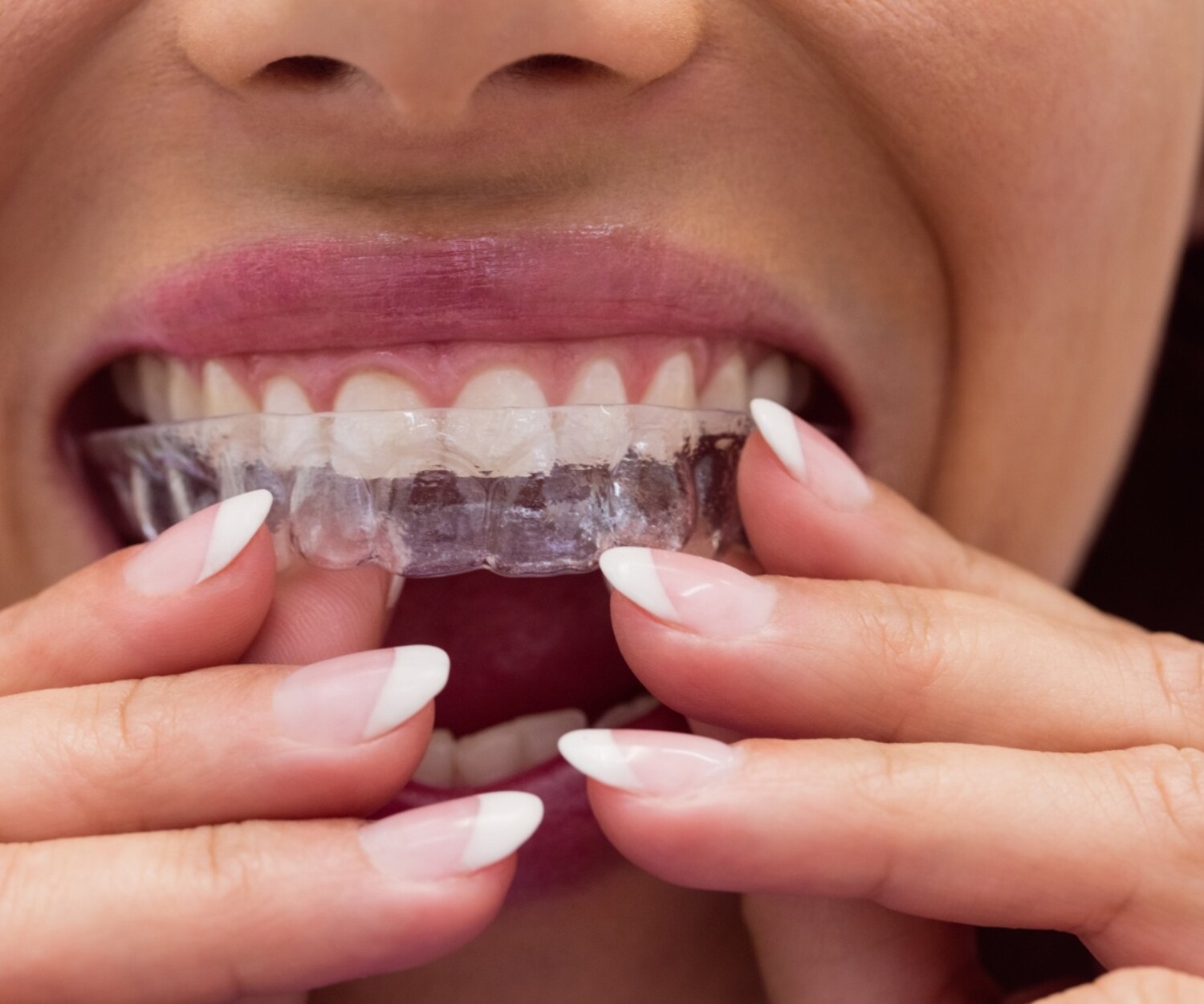 Patient placing clear aligners while comparing ClearCorrect vs Invisalign treatment options