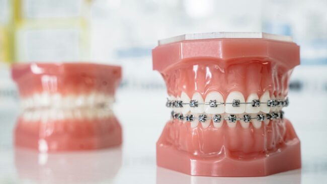 Dental model with metal braces