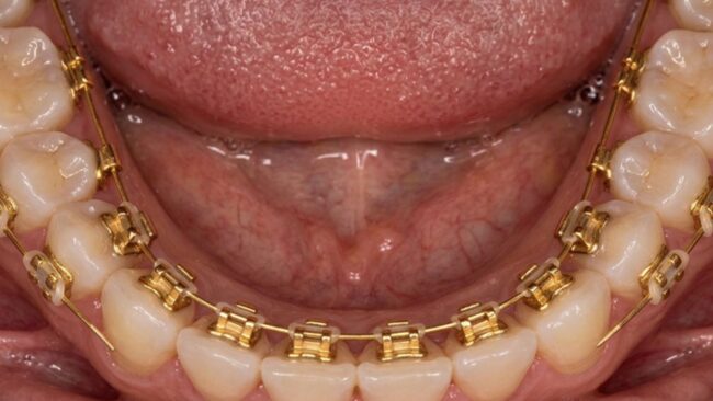 Lingual braces