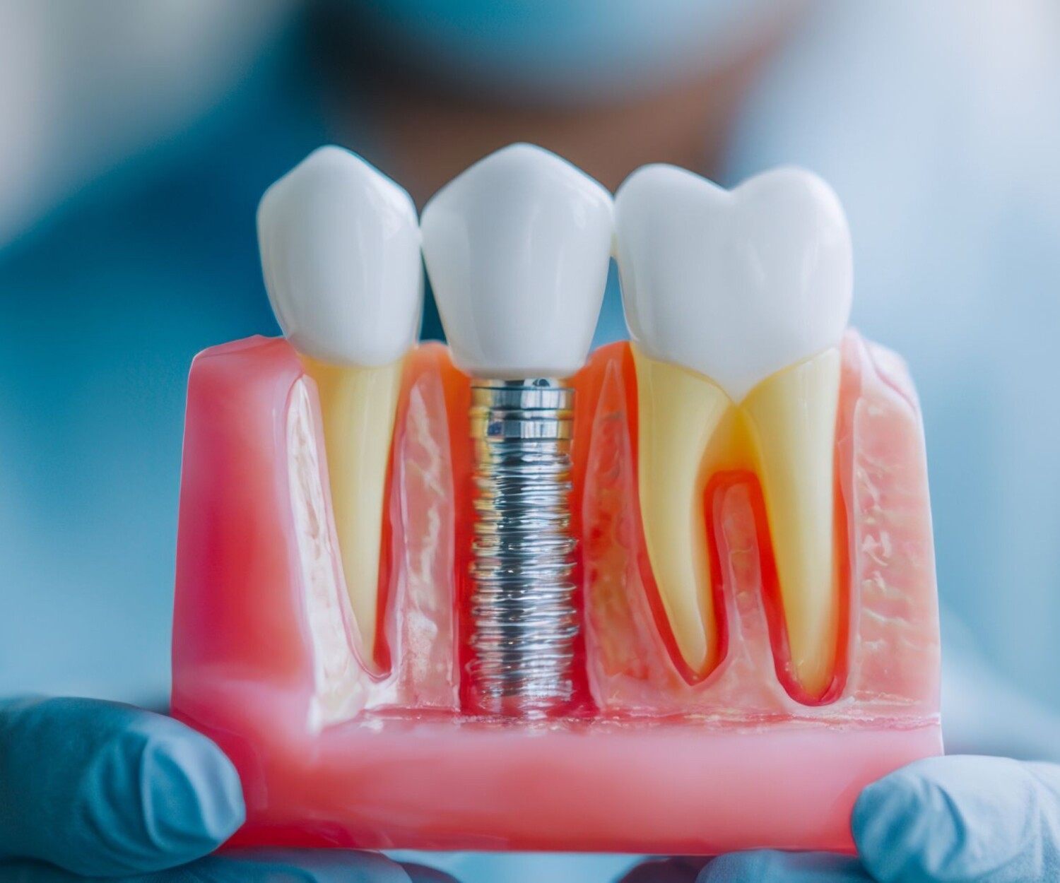 Dental Implant