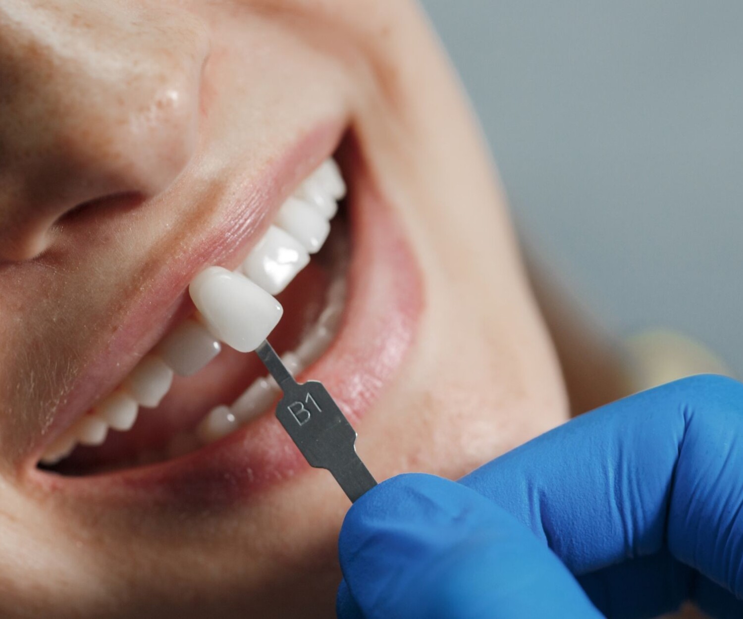 Dentist placing a veneer on a patient's teeth