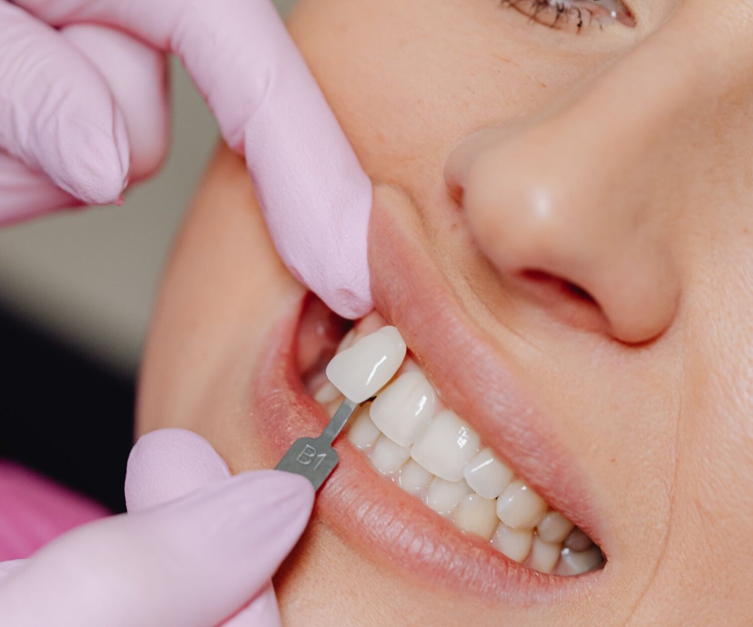 Woman getting a venner placed by a dentist
