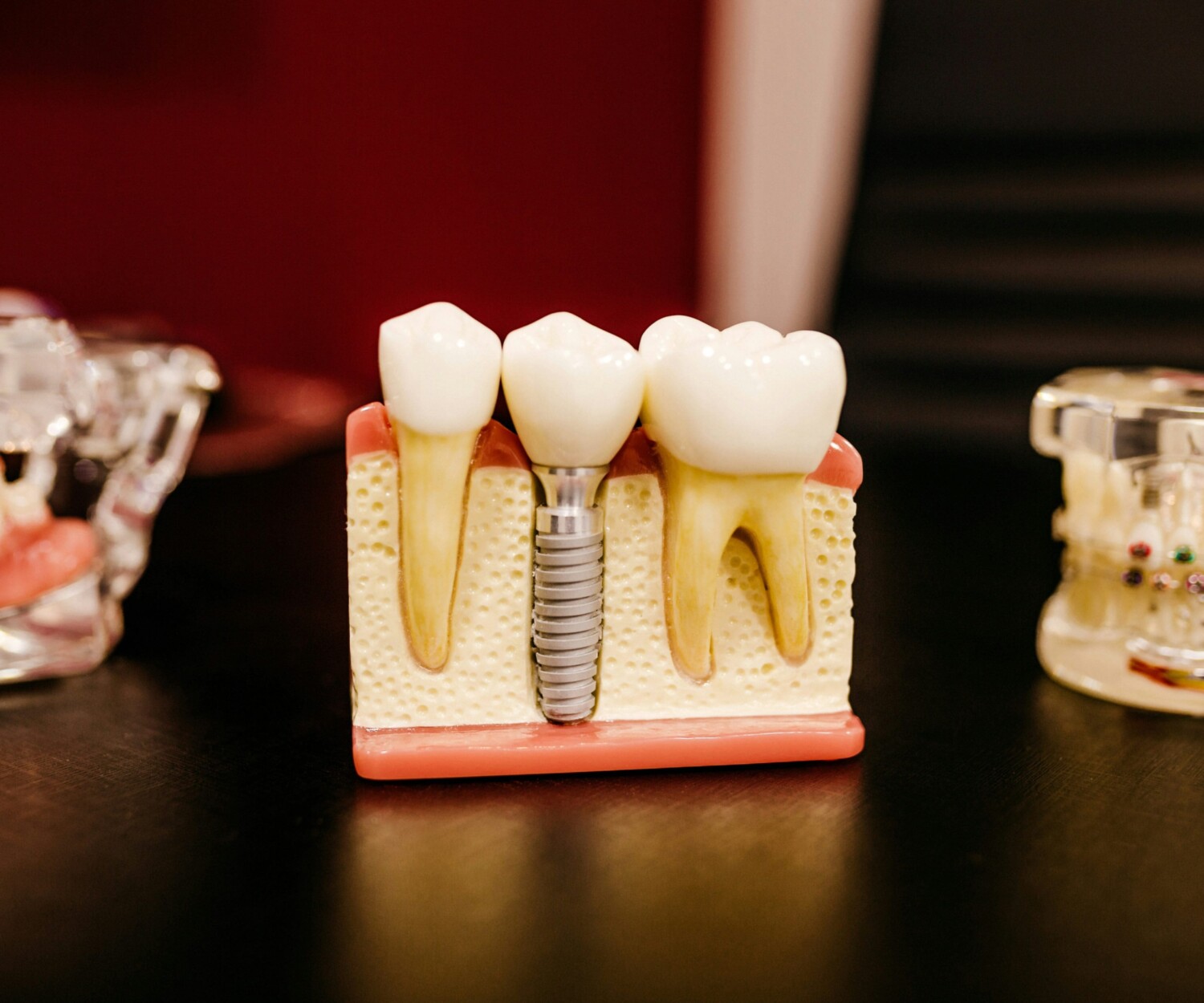 mini dental implants